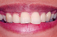 veneer1.jpg