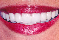 veneer2.jpg